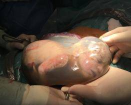 Lékaři v Baťově nemocnici se snaží nedonošené děti rodit šetrněji, ve vaku blan