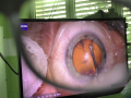 Oční oddělení dostane nový operační mikroskop